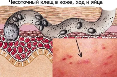 Як виглядає короста у людини симптоми і ознаки, як розпізнати в домашніх умовах (короста) Як виглядає короста у людини симптоми і ознаки, як розпізнати в домашніх умовах