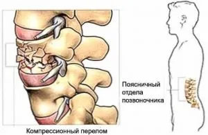 Компресійний перелом хребта поперекового відділу симптоми, методи лікування, реабілітація