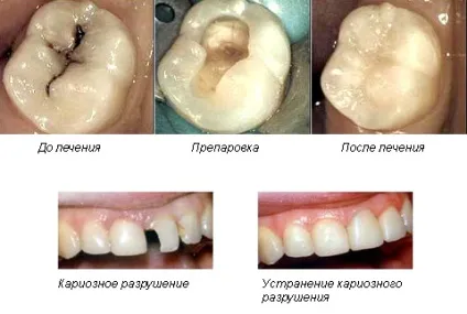 Компенсована форма карієсу діагностика, лікування, ускладнення (лікування) Компенсована форма карієсу діагностика, лікування, ускладнення