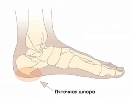 Коректори стопи, ортекс - ортопедичний салон
