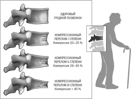 Компресійний перелом хребта поперекового відділу лікування, наслідки (хребта) Компресійний перелом хребта поперекового відділу лікування, наслідки