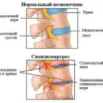 Лікування подагри народними засобами в домашніх умовах (народними) Лікування подагри народними засобами в домашніх умовах