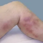 лікування флебита