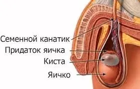 Лікування кісти яєчка народними засобами (засобами) Лікування кісти яєчка народними засобами