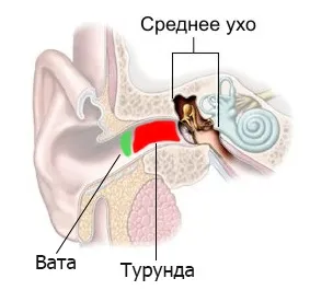 Лікування отиту в домашніх умовах - відповідь тут! (Домашніх) Лікування отиту в домашніх умовах - відповідь тут!