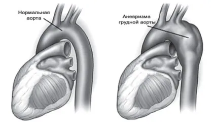 Лікування аневризм аорти