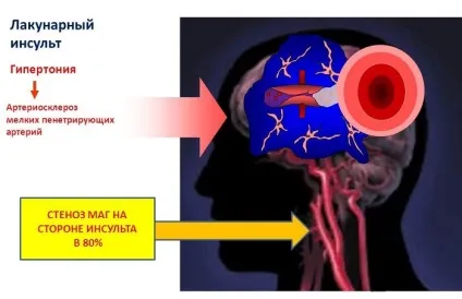 Лакунарний ішемічний інсульт і лакунарний інфаркт головного мозку - що це таке (головного) Лакунарний ішемічний інсульт і лакунарний інфаркт головного мозку - що це таке