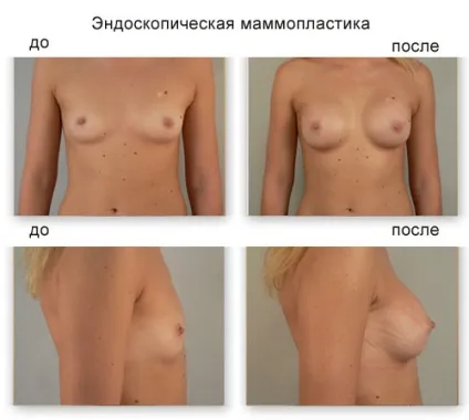 Мамопластика 3 розмір - до і після