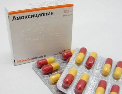 Мірінгіт вуха гострий, бульозний, симптоми і лікування (лікування) Мірінгіт вуха гострий, бульозний, симптоми і лікування
