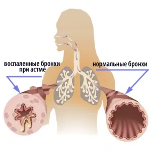 Немедикаментозне лікування бронхіальної астми, secretwoman (лікування) Немедикаментозне лікування бронхіальної астми, secretwoman