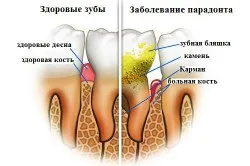Оголення шийки зуба лікування народними засобами (шийки) Оголення шийки зуба лікування народними засобами