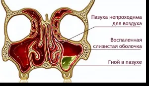 Одонтогенний гайморит причини виникнення та способи лікування (причини) Одонтогенний гайморит причини виникнення та способи лікування