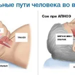Зупинка дихання уві сні причини і лікування у дорослих