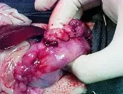 Ускладнення і наслідки при виразці 12 палої кишки