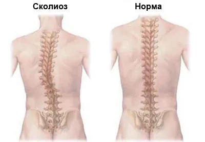 Ортопедичний корсет при сколіозі хребта 1-4 ступеня, який потрібен, як правильно вибрати (правильно) Ортопедичний корсет при сколіозі хребта 1-4 ступеня, який потрібен, як правильно вибрати