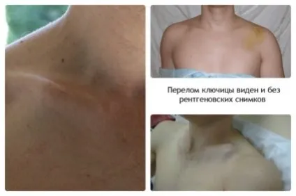 Перелом ключиці зі зміщенням, його симптоми і лікування (лікування) Перелом ключиці зі зміщенням, його симптоми і лікування