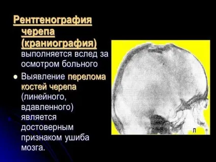 Перелом черепа наслідки методи лікування фото і відео (лікування) Перелом черепа наслідки методи лікування фото і відео