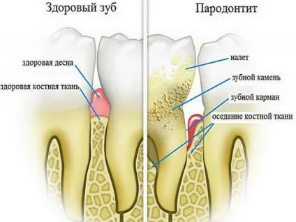 Пародонтоз лікування в домашніх умовах народними засобами (домашніх) Пародонтоз лікування в домашніх умовах народними засобами
