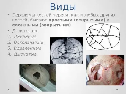 Перелом черепа наслідки методи лікування фото і відео (перелом) Перелом черепа наслідки методи лікування фото і відео