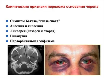 Перелом черепа наслідки методи лікування фото і відео (перелом) Перелом черепа наслідки методи лікування фото і відео