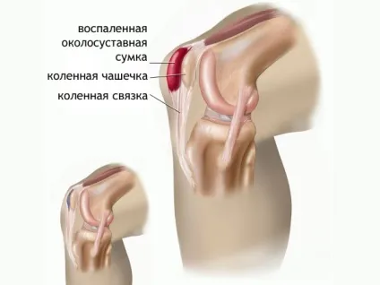 Побічні ефекти дипроспана