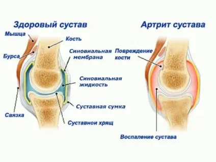 Побічні ефекти дипроспана