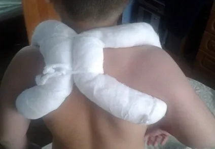 Пов'язка при переломі ключиці кільця Дельбе, пов'язка Дезо (переломі) Пов'язка при переломі ключиці кільця Дельбе, пов'язка Дезо