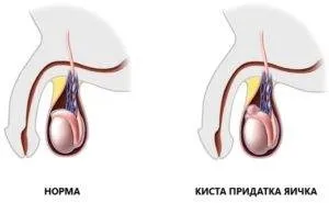 Препарати від кісти яєчка чоловіків, чи можна вилікувати кісту яєчка у чоловіків ліками, можливе (яєчка) Препарати від кісти яєчка чоловіків, чи можна вилікувати кісту яєчка у чоловіків ліками, можливе