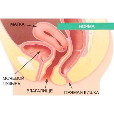 пролапс генеталій