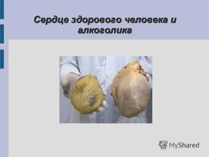 Презентація на тему захворювання серцево-судинної системи (тему) Презентація на тему захворювання серцево-судинної системи