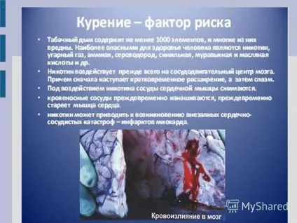 Презентація на тему захворювання серцево-судинної системи (захворювання серцево-судинної системи. Про це потрібно знати? Проблема: висока смертність від серцево-судинних захворювань в порівнянні з іншими країнами.) Презентація на тему захворювання серцево-судинної системи
