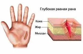 рвані рани