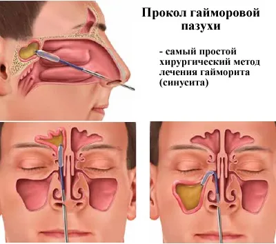 Синусит причини виникнення, діагностика, симптоми, лікування і профілактика з