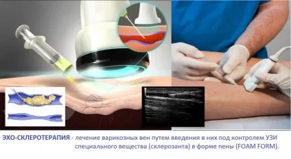 Склеротерапія вен нижніх кінцівок - фото і відео (кінцівок) Склеротерапія вен нижніх кінцівок - фото і відео