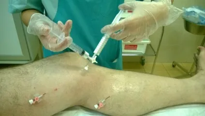 Склеротерапія вен нижніх кінцівок - фото і відео (кінцівок) Склеротерапія вен нижніх кінцівок - фото і відео