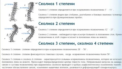 Сколіоз і армія - це речі несумісні (діагностика) Сколіоз і армія - це речі несумісні