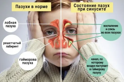Синусит причини виникнення, діагностика, симптоми, лікування і профілактика з