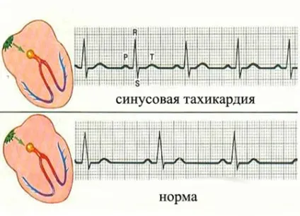 Синусова тахікардія небезпечна і що це таке (відділу нервової системи) Синусова тахікардія небезпечна і що це таке