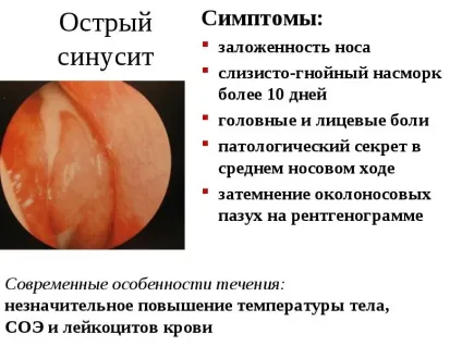 Синусит причини виникнення, діагностика, симптоми, лікування і профілактика з