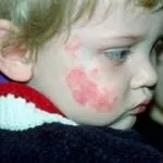 Судинна гемангіома види, симптоми і лікування (лікування) Судинна гемангіома види, симптоми і лікування