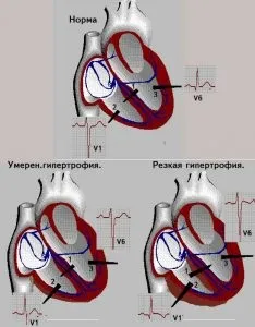 Стадії інфаркту міокарда і особливості кожної з них (стадії інфаркту міокарда) Стадії інфаркту міокарда і особливості кожної з них