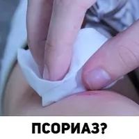 Поперековий лишай симптоми і лікування (протягом декількох місяців) Поперековий лишай симптоми і лікування