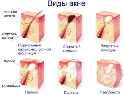 Підвищений тестостерон у чоловіків що це значить, симптоми, наслідки