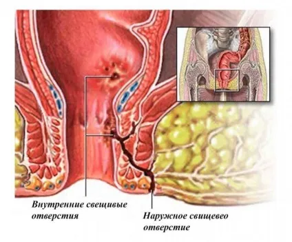 Післяопераційний свищ особливості загоєння і лікування (зачіпають черевну порожнину) Післяопераційний свищ особливості загоєння і лікування