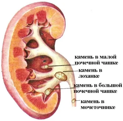 Камені в нирках розміри, які можуть самі вийти (розміри) Камені в нирках розміри, які можуть самі вийти