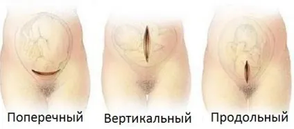 Чи загрожує шов на матці після кесарева повторної вагітності та пологах (вагітності) Чи загрожує шов на матці після кесарева повторної вагітності та пологах