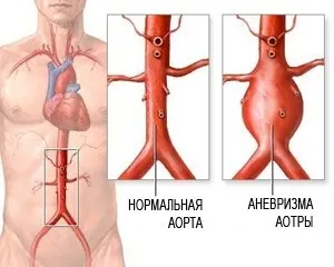 Узі черевної аорти
