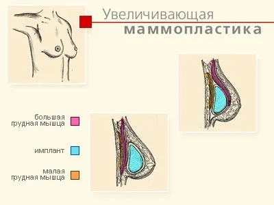 Збільшення грудей ціна та відгуки про операцію по маммопластике (збільшення) Збільшення грудей ціна та відгуки про операцію по маммопластике