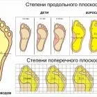 Види плоскостопості і як боротися з плоскостопістю (плоскостопості) Види плоскостопості і як боротися з плоскостопістю