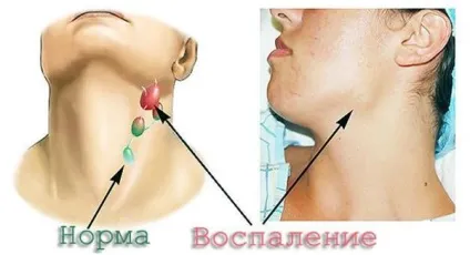 Вузли в щитовидній залозі симптоми і наслідки (залозі) Вузли в щитовидній залозі симптоми і наслідки